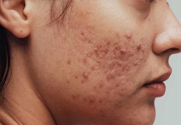 Closeup of acne on person's cheek, with their profile to camera.