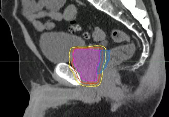 Prostate SAbR 650&#215;450