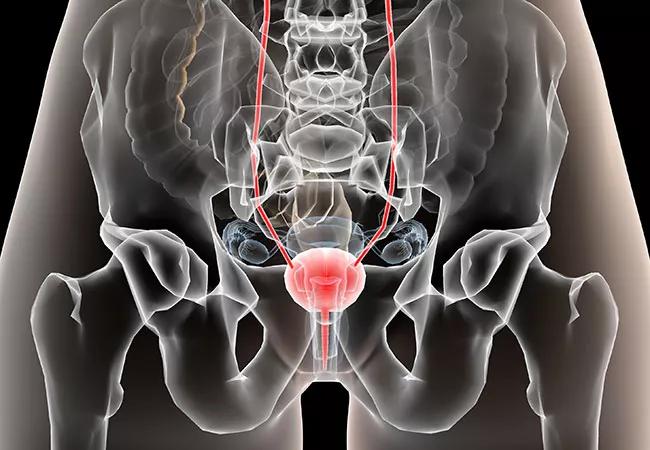 650&#215;450-Bladder-Cancer