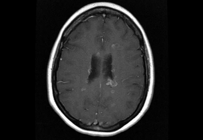 19-NEU-3979-relapsing-multiple-sclerosis-650&#215;450