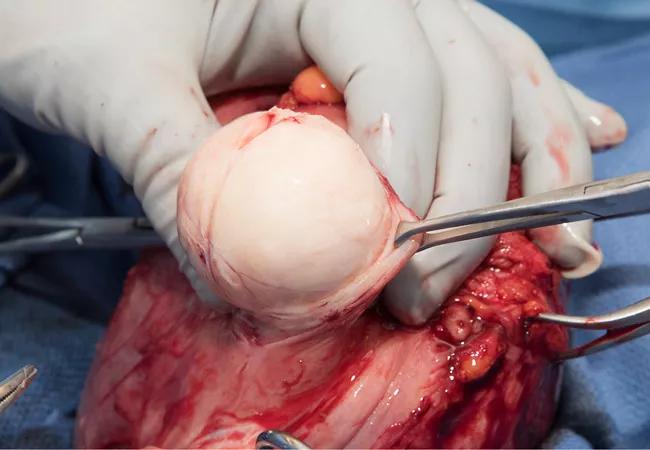 fibroid_650x450