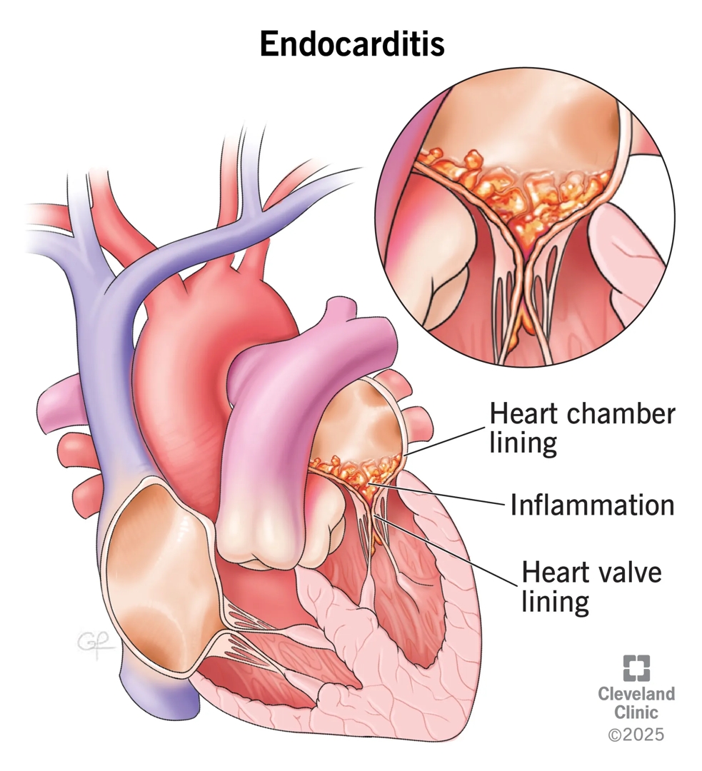 Illustration of endocarditis.