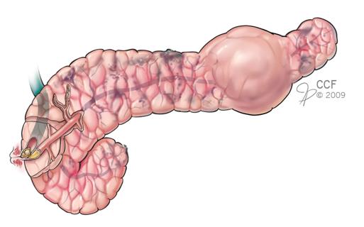 Pancreatitis