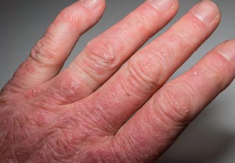 close-up of hand with Psoriatic Arthritis