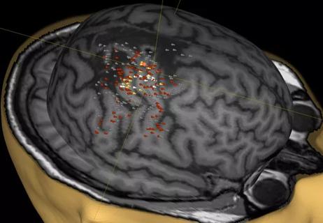 20-NEU-1915483 Navigated TMS to guide management of refractory epilepsy_CQD_650x450