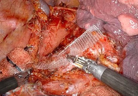 intraoperative photo of robotic tracheobronchoplasty