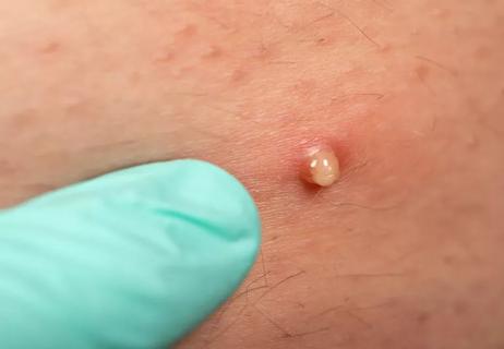 Closeup of healthcare provider examining an ingrown hair follicle.