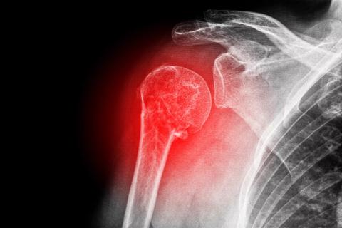 Treatment advances for frozen shoulder