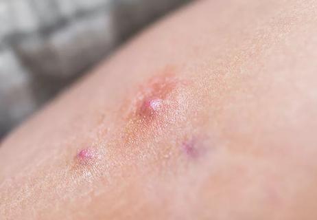 Red, purple bumps on the surface of someone's skin.