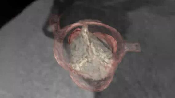 3D reconstruction of aortic root in congenital heart disease