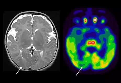 21-NEU-2340463-brain-imaging-pediatric-focal-cortical-dysplasia-650&#215;450