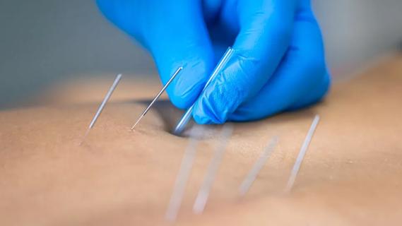 Dry needling