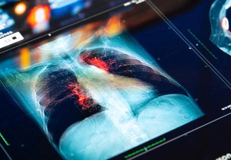 Lung Cancer Screening