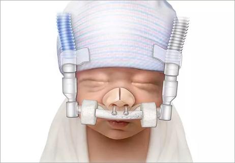 650&#215;450-Aly-Bubble-CPAP