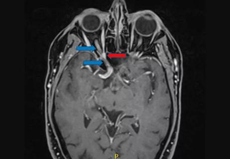 21-NEU-2051980 schwannoma of lacrimal nerve_650x450