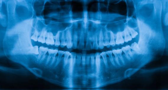Panoramic X-ray of jaw and teeth