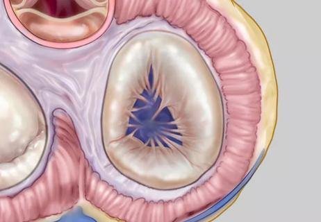 22-HVI-3413075_illustration-of-pulmonary-valve_650x450