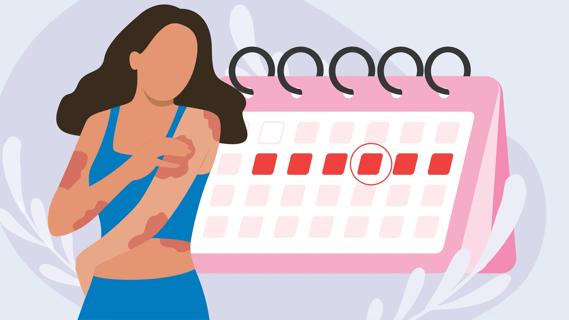 Woman with patchy hives on body, with oversized calendar indicating menstrual cycle