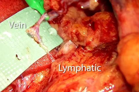 19-CNR-4017 Reducing lymphedema risk 650 x 450