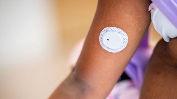 Continuous Glucose Monitoring