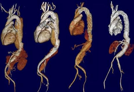 22-HVI-3361352_staged-thoracoabdominal-aortic-aneurysm-repair_650x450