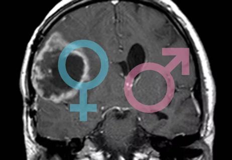 20-NEU-1975326_sex differences in glioblastoma_650x450