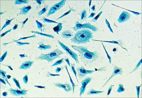 prostate-cancer-cells_650x450