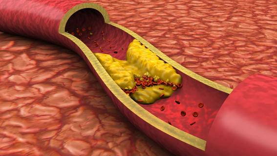 Cholesterol