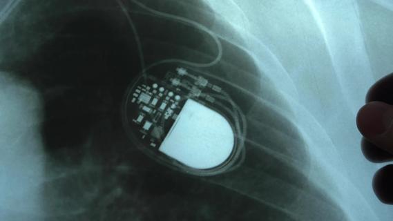 Pacemaker