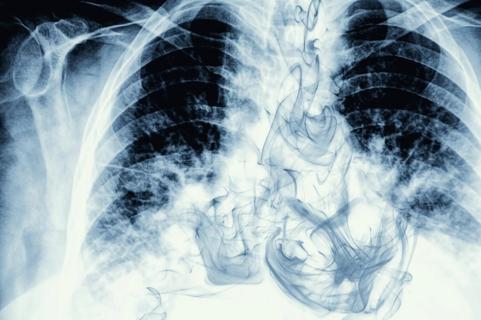 Smoke visible on chest X-ray image