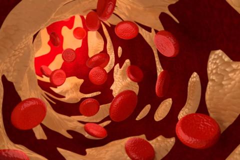 Artist's rendering of fatty deposits in the bloodstream.