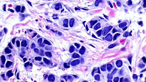 Lobular breast cancer cells