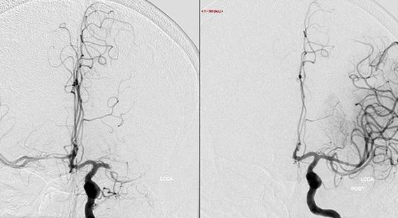 large vessel occlusion before and after treatment