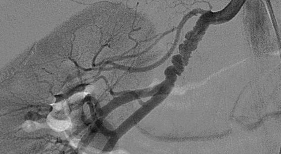 Angiogram images of FMD