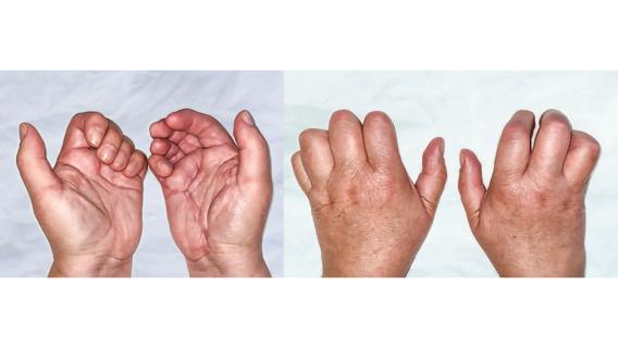 swollen hands