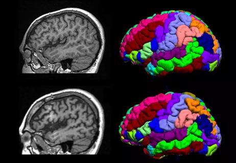 18-NEU-509-Nakamura-Volumetric-MRI-650&#215;450