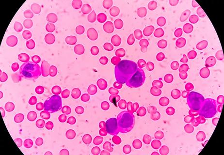 Photomicrograph of Acute Myeloblastic Leukemia (AML), a cancer of white blood cell