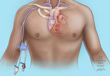 20-DDI-1971367-CQD-Tunneled-Intravenous-Catheters