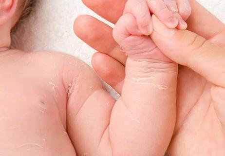 newborn baby skin peeling