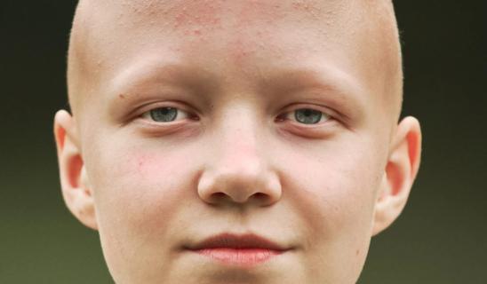 Patient with alopecia