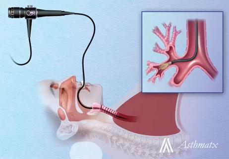 Bronchial Thermoplasty