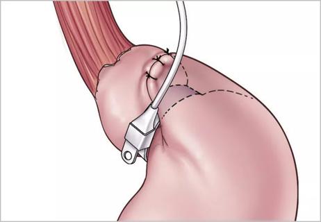 Medical illustration of bariatric surgery