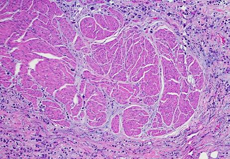 Plasmacytoid variant of urothelial carcinoma