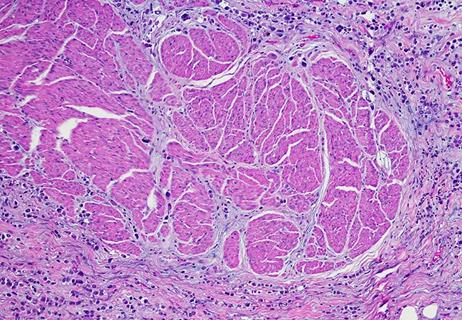 Plasmacytoid variant of urothelial carcinoma
