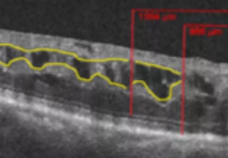 Predicting Visual Acuity Response to Anti-VEGF Therapy in Macular Edema Secondary to RVO