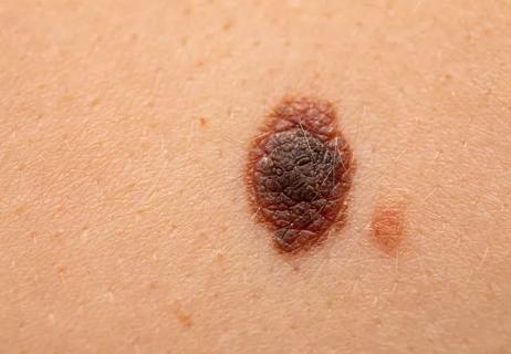 mole skin cancer