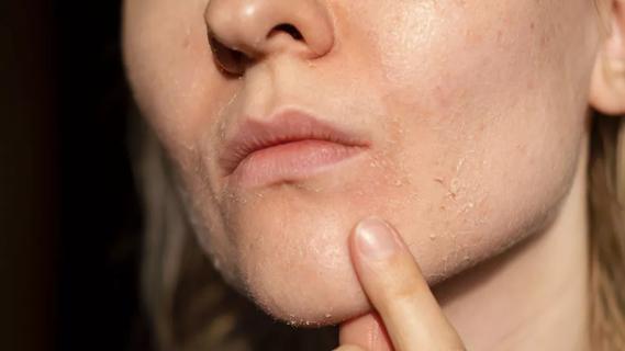 person examining flaky skin on face