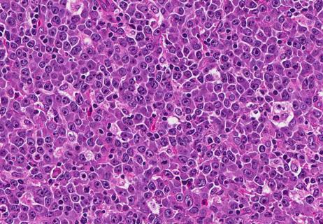 DLBCL-HE-40x_650x450
