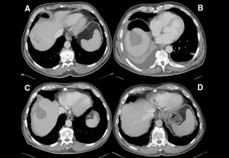 Computerized tomography images of a patient with 3 liver metastases A treated with laparoscopic radiofrequency ablation.