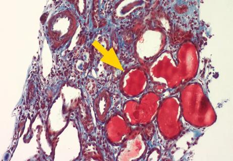 lupus nephritis